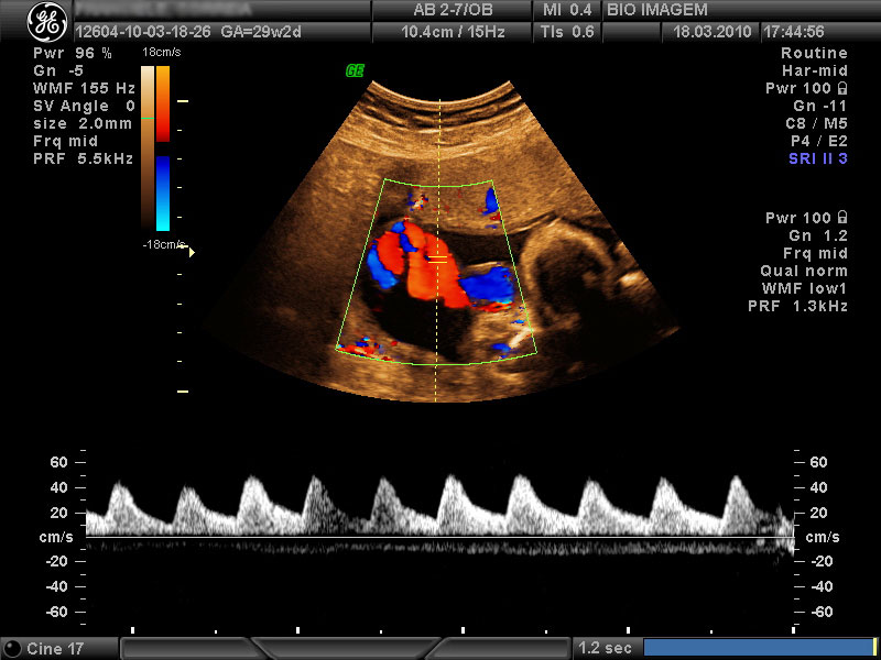 Color Doppler with Flow Studies